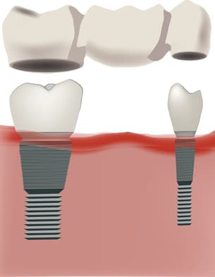 Dental implants with bridge