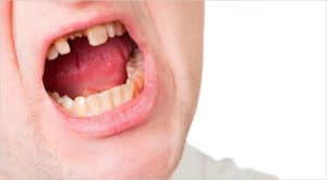 dental bonding for tmj treatment 5c9a4cdd60600