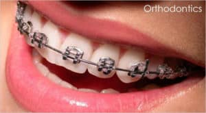 orthodontic treatment 5c9a4f879f2d0