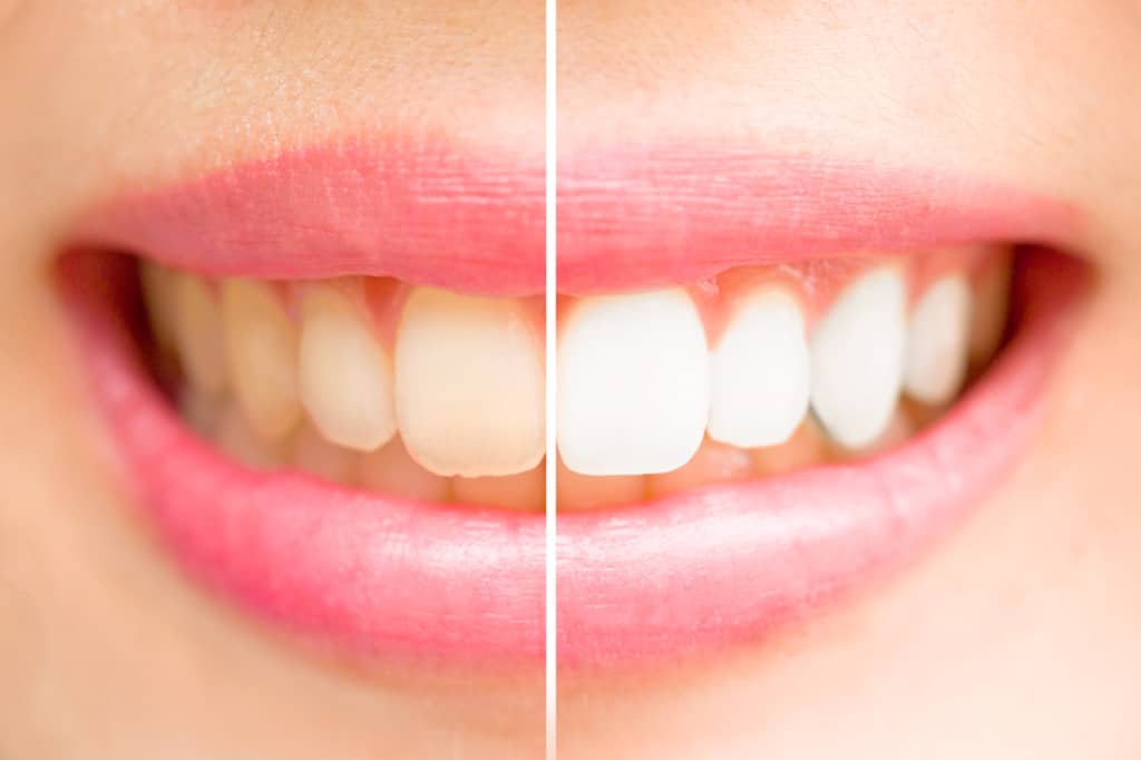 teeth whitening racine