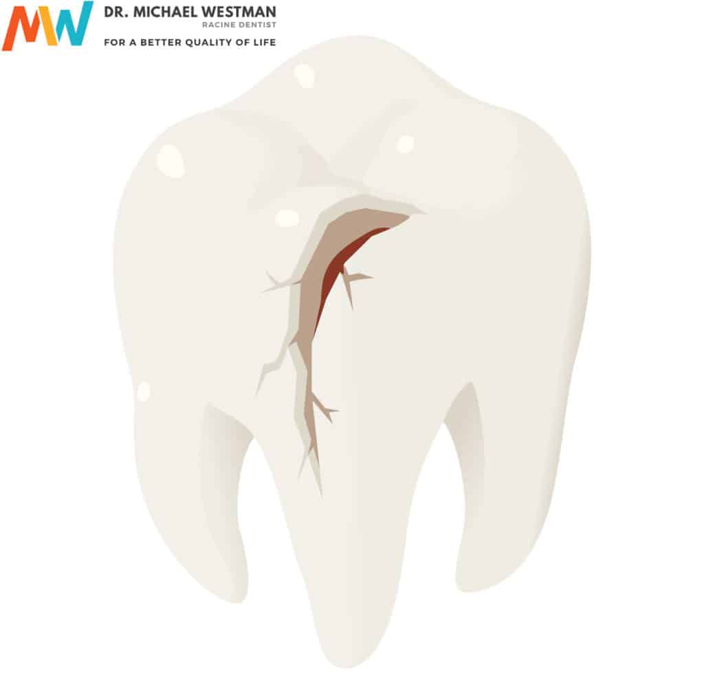 damaged_tooth_racine_wisconsin
