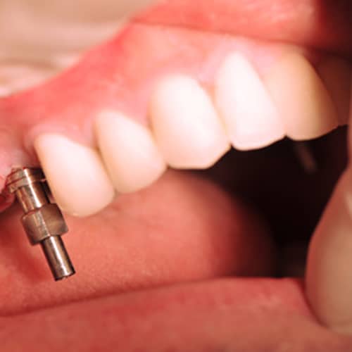 Dental Implants in Racine Wisconsin