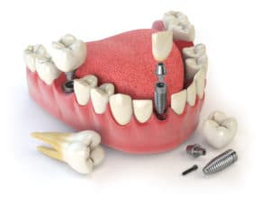 dental implant example 1 300x225 1