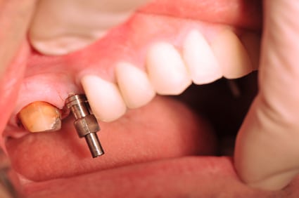 dental implants2