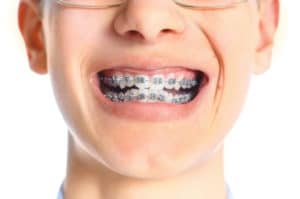 dental braces for kids